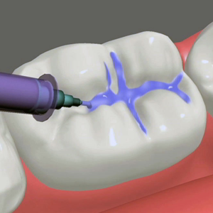 Dental Sealants